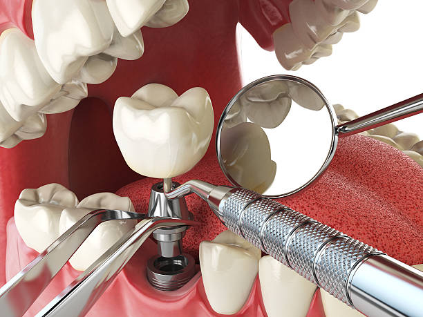 Best Emergency Treatment for Dental Infections or Abscesses in Carthage, IL